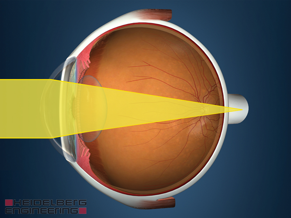 Vision Impairment Myopia Hyperopia Presbyopia Know The Eye