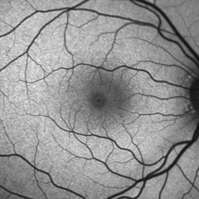 abnormal Amsler Grid test- Retina Ophthalmology Gettysburg PA & Frederick  MD - Greater Potomac Retina - Greater Potomac Retina