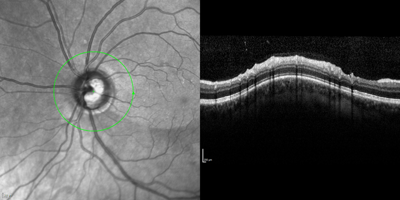 Examinations Of The Optic Nerve Head Know The Eye