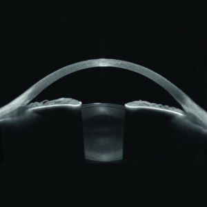 Hochaufgelöste Visualisierung des gesamten vorderen Augenabschnitts, von der Vorderseite der Hornhaut bis zur Rückseite der Linse.
